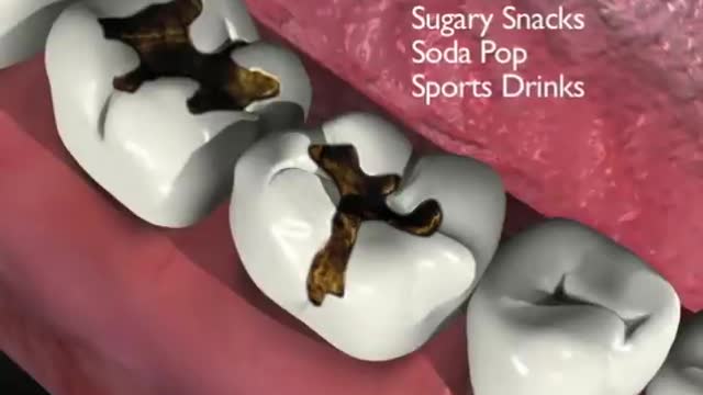 Tooth Decay/Cavities / Dental Caries