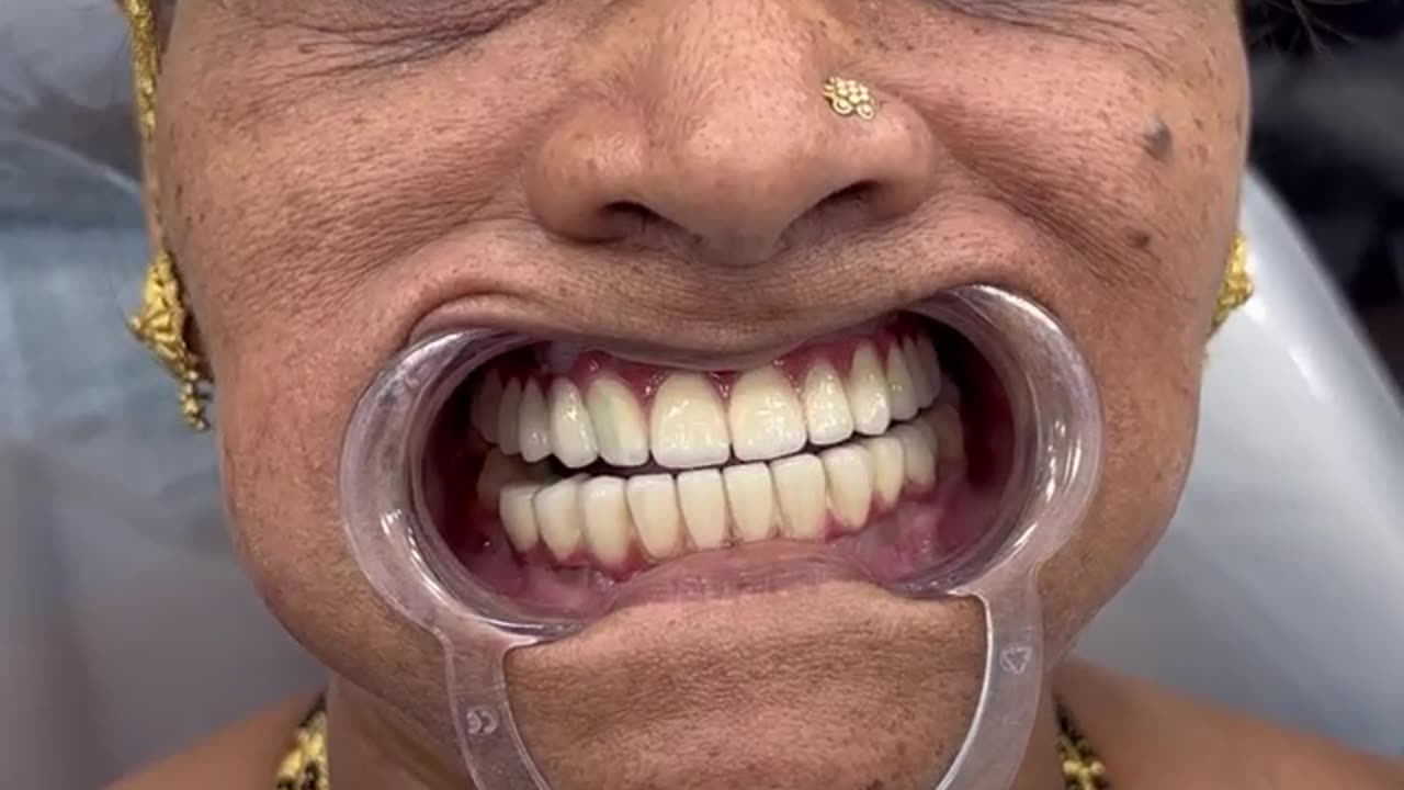 Full Mouth Reconstruction Treatment in Navi Mumbai