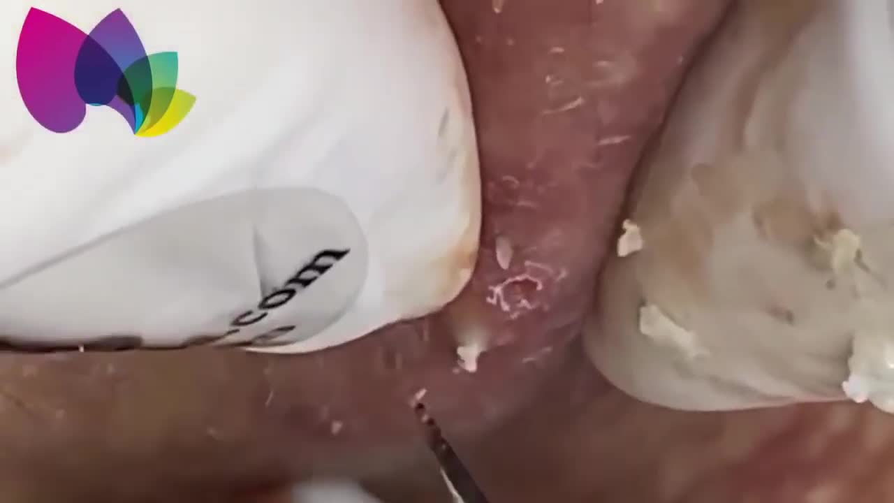 Blackheads & Milia, Big Cystic Acne Blackheads Extraction Whiteheads Removal Pimple Popping №1