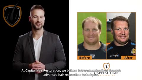 Capital Hair Restoration - Hair Transplant