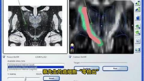 細胞治療奏效 3大癌存活期增5倍