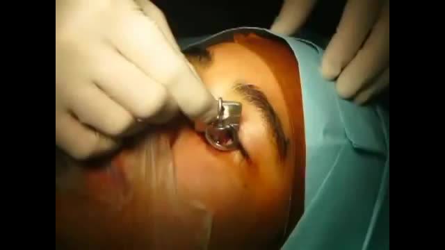 Removal of Key From My Eye