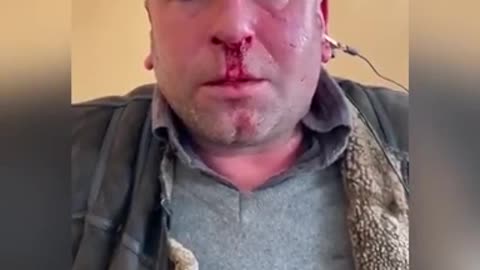 Captured Ukrainian Soldier with Evidence of Torture