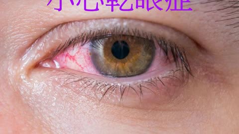 「5大症狀」 小心乾眼症