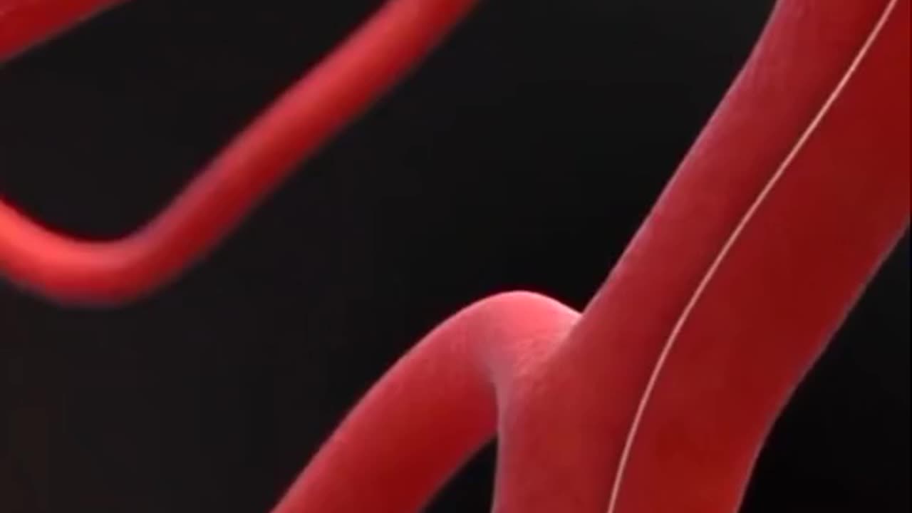 Brain Blood Clot Removal Technique 3D Animation