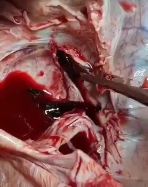 AUTÓPSIA: TROMBOSE CEREBRAL - VÍTIMA DA VACINA