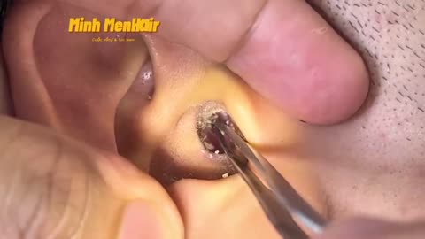 Wax ear infection removed