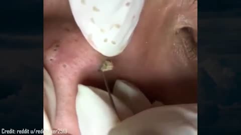 Espremendo cravos e espinhas! Vídeo Estranhamente satisfatório.