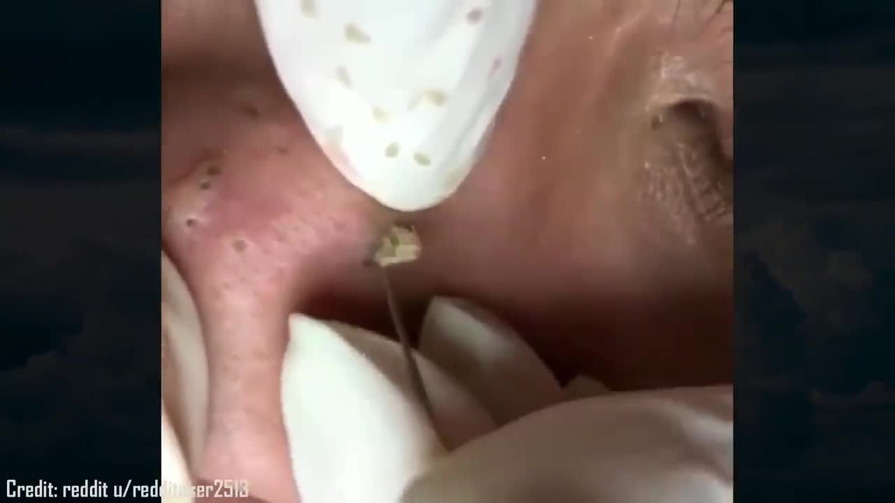 Espremendo cravos e espinhas! Vídeo Estranhamente satisfatório.