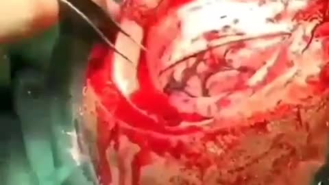 Massive Blood Clot (Viewer discretion advised)