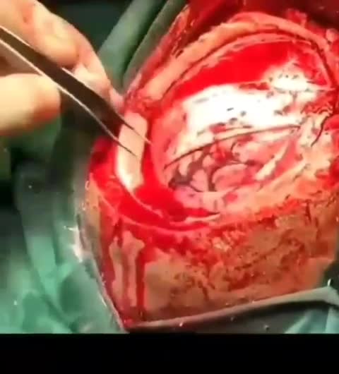 Massive Blood Clot (Viewer discretion advised)