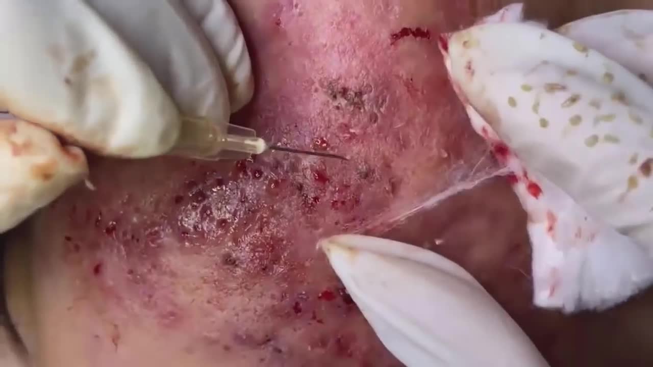 Big Cystic Acne Blackheads Extraction Blackheads & Milia, Whiteheads Removal Pimple Popping