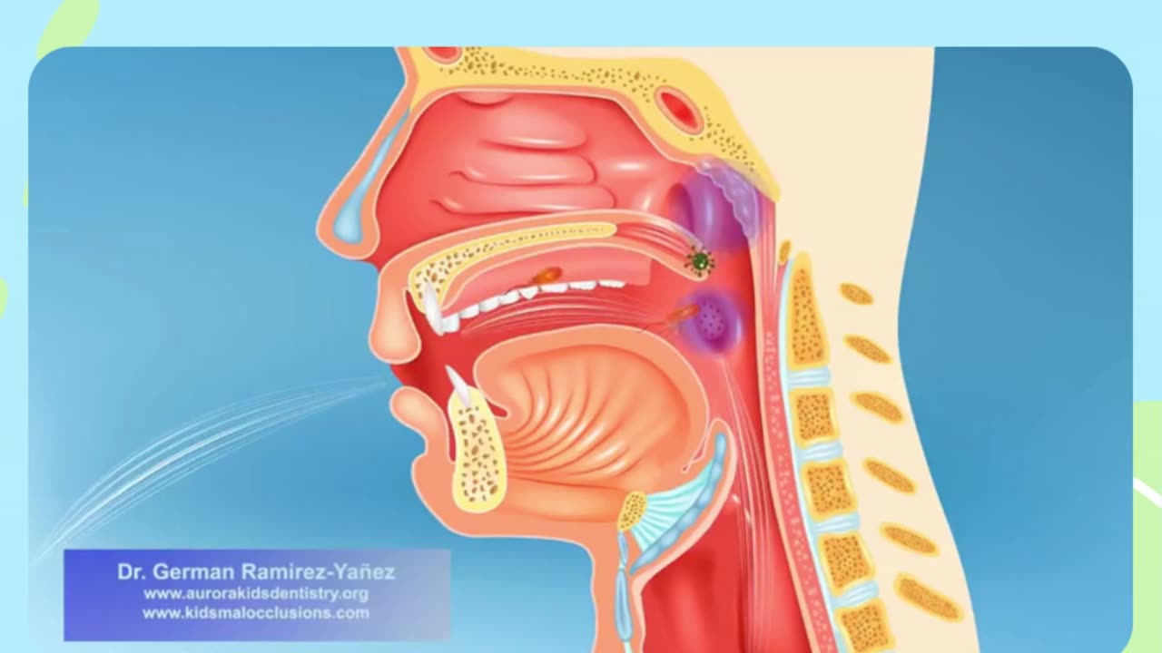 Mouth Breathing In Children by Dr. German Ramirez