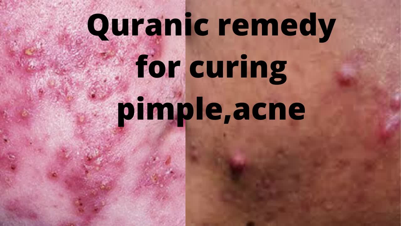 Dua to cure Pimples,Skin diseases etc.العلاج القرآني لعلاج البثور والأمراض الجلدية