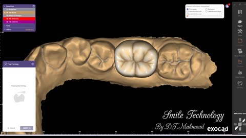 #design #naildesign #dental #dentaldesign #exocadexpert