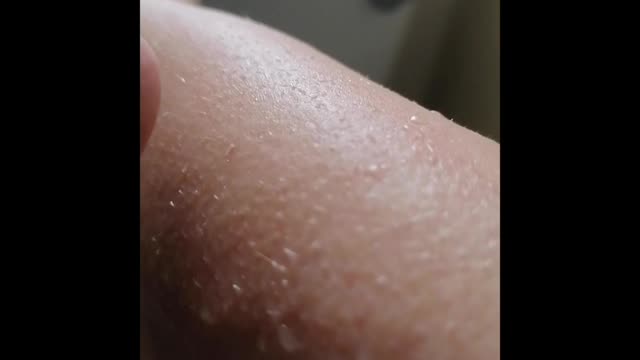 Morgellons worms like creatures nano tech wiggling something to help
