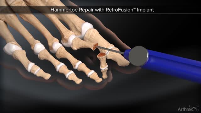 Hammertoe Repair With Retro Fusion