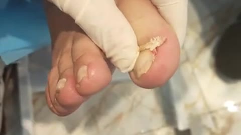 Big ingrown toenail pain