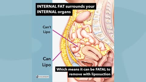 Understanding Internal vs External Fat and Liposuction