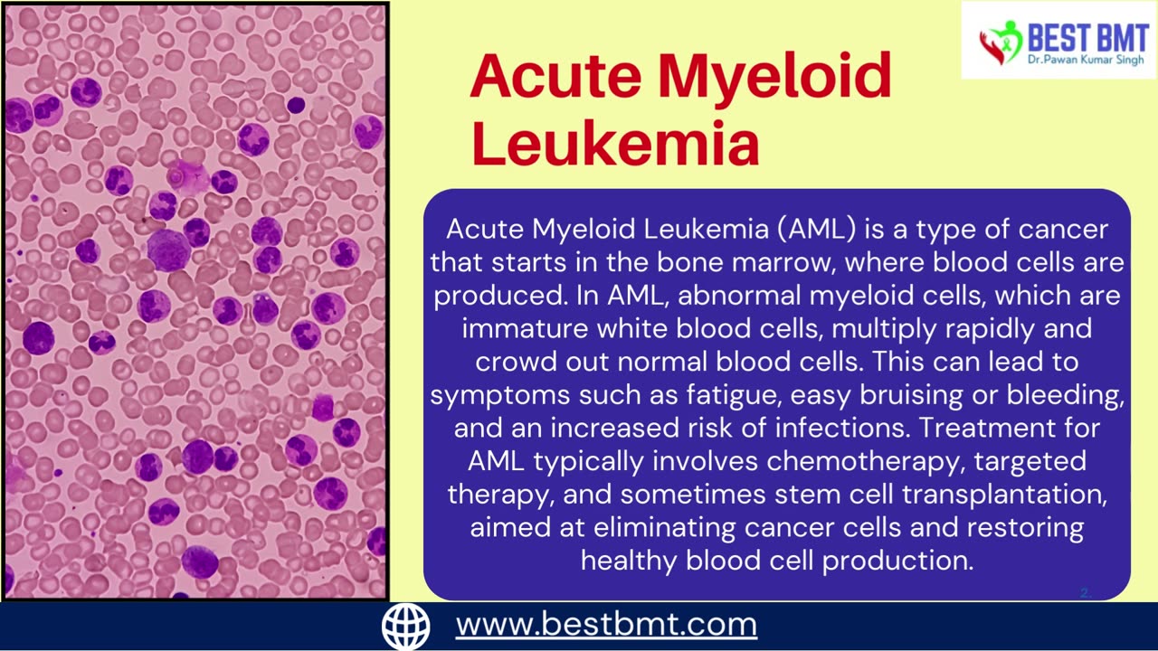 Understanding of Acute Myeloid Leukemia