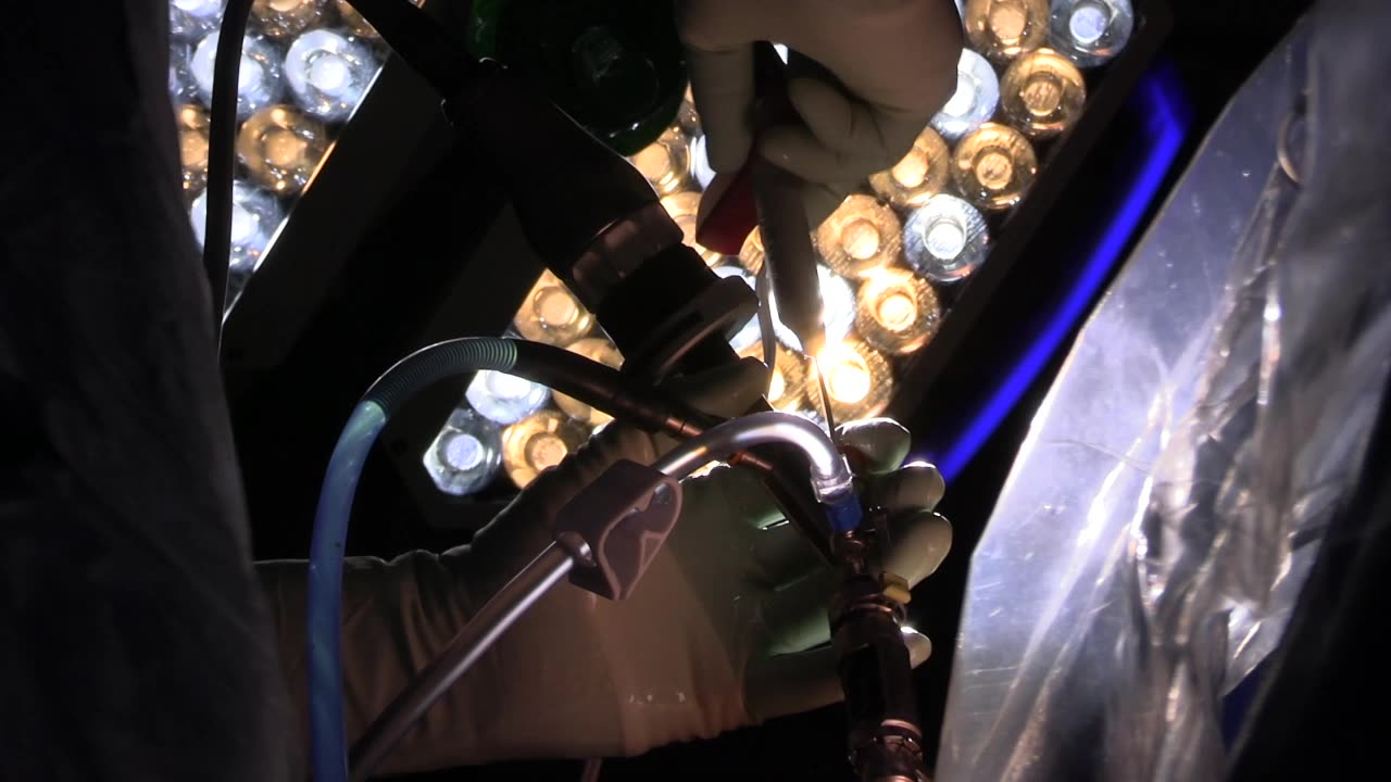ANNUOPLASTY
