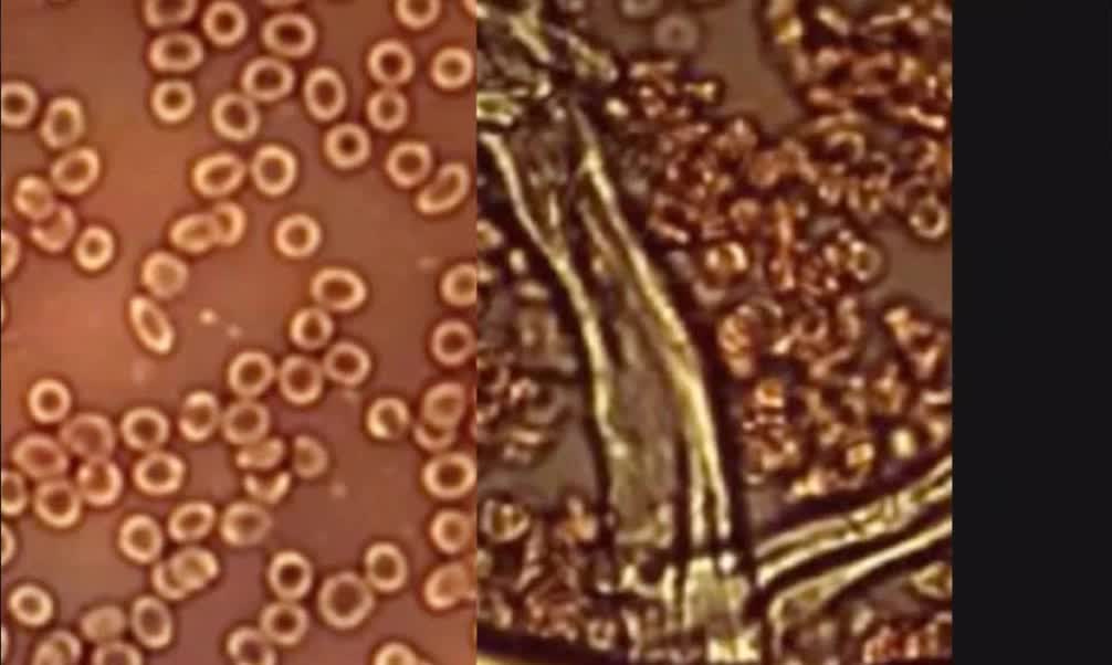 COVID 19 BLOOD DAMAGE