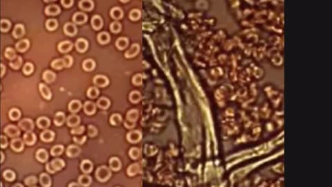 COVID 19 BLOOD DAMAGE