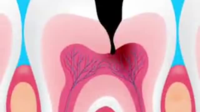 What happens if tooth decay is left untreated