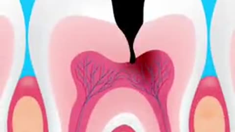 What happens if tooth decay is left untreated