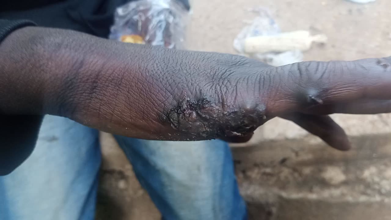 Jiggers attack zablon palm