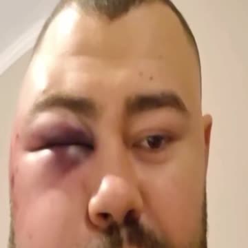 After match face condition of UFC Campion