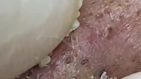 pimple popping
