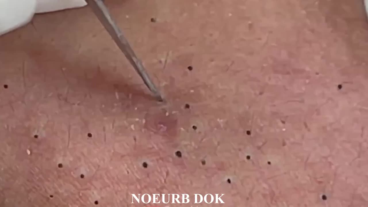 Blackhead Popping- Satisfying Video 1