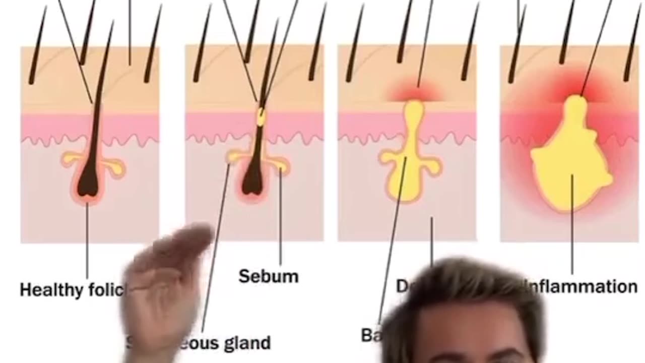 What Pimple Popping Extractions Look Like Up Close #shorts