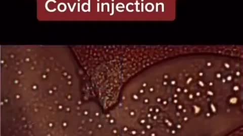 Moderna Covid-19 Vaccination changes your blood - just have a look and share the information