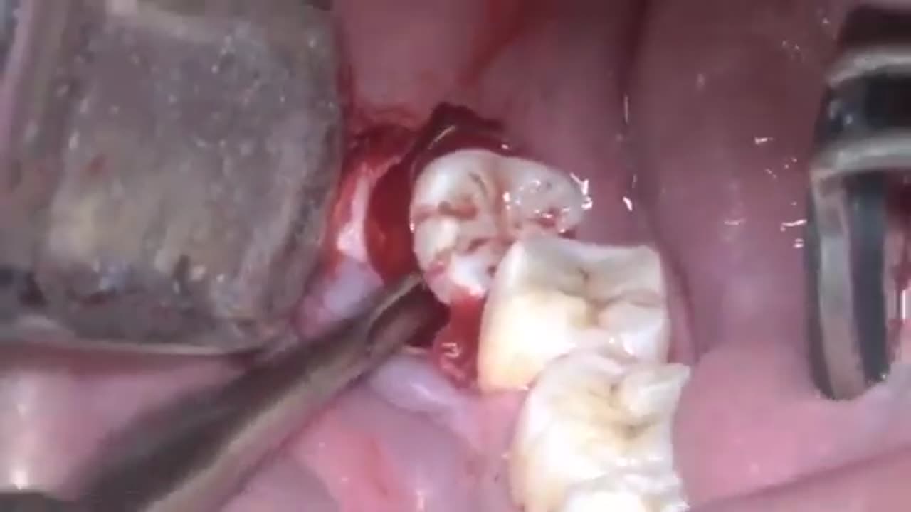 Third Molar extraction, Wisdom tooth extraction, extraction, dentistry