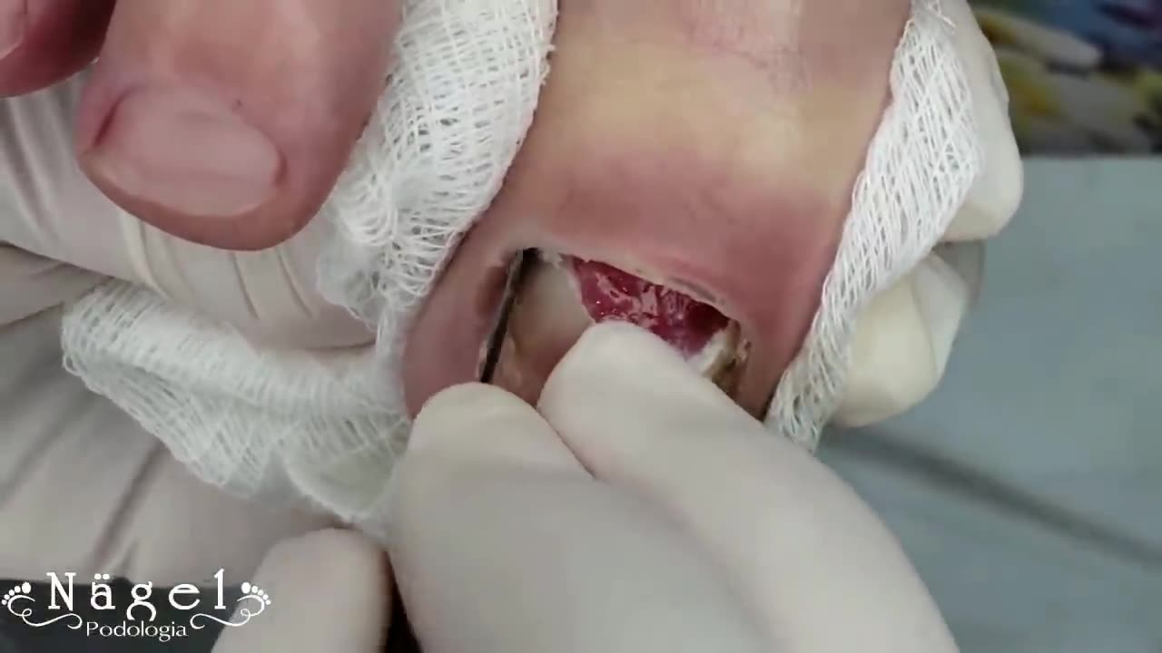 INGROWN NAIL