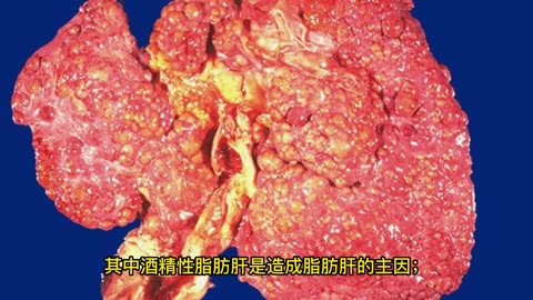 脂肪肝三大迷思！ 減肥也會肝包油
