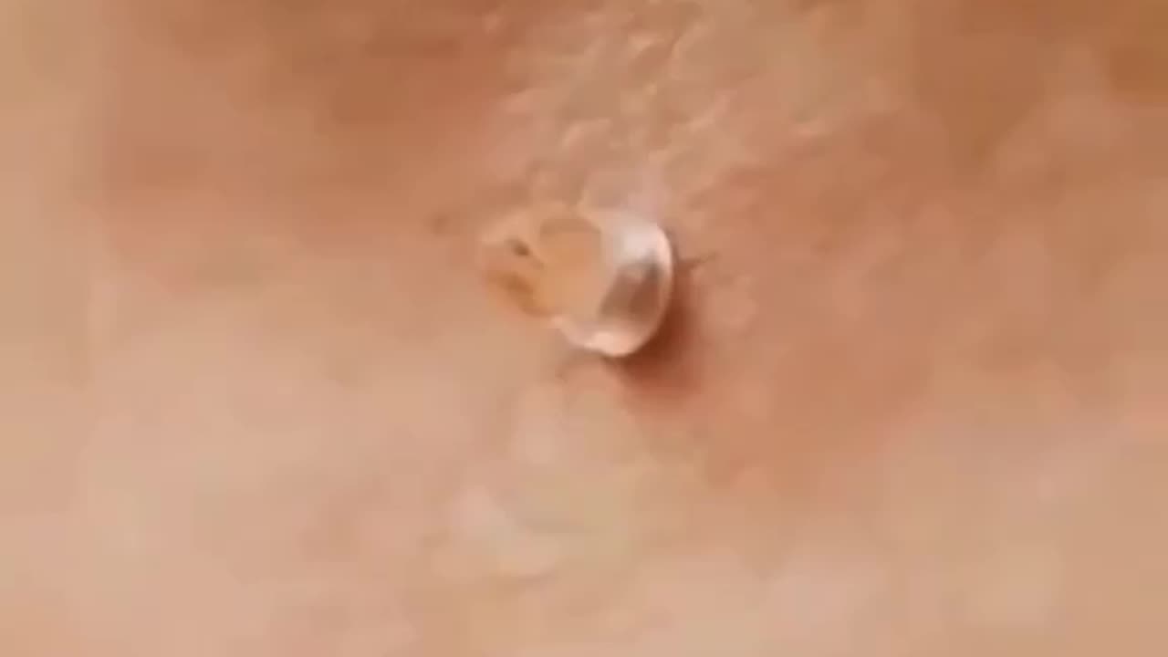 skin Tag Remover. Get ride of those unsightly skin tags and regain your confidence