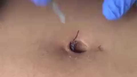 UNKNOWN BUG STUCK IN HER BELLY BUTTON