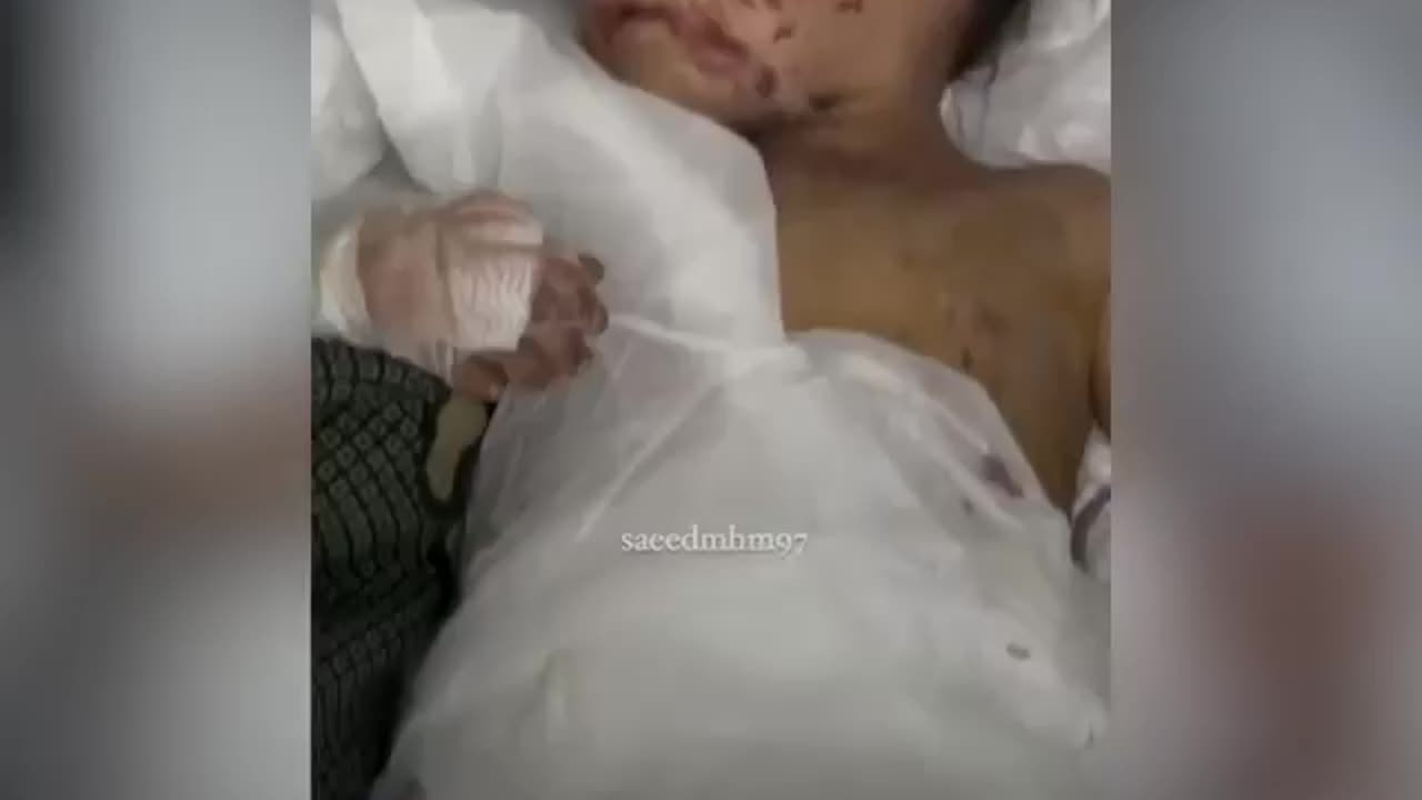 The two Palestinian sisters, Misk and Hanan, have had their limbs amputated