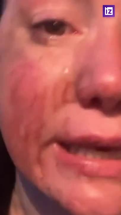 Aggredita e picchiata in Italia, l'attrice Agniya Mishchenko-Brodskaya.