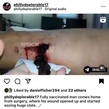 Arm blood clot from death vaccine