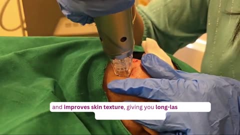 Micro needling Radio Frequency Treatment for Acne | Skin Clinic in Sarjapur Road | SK Truderma