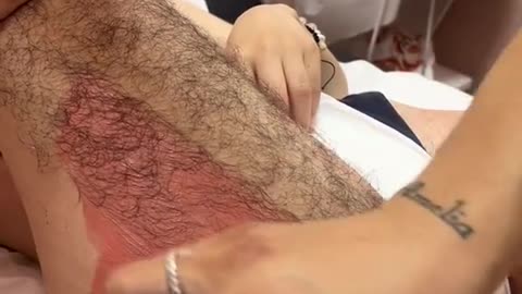 Hair removal techniques