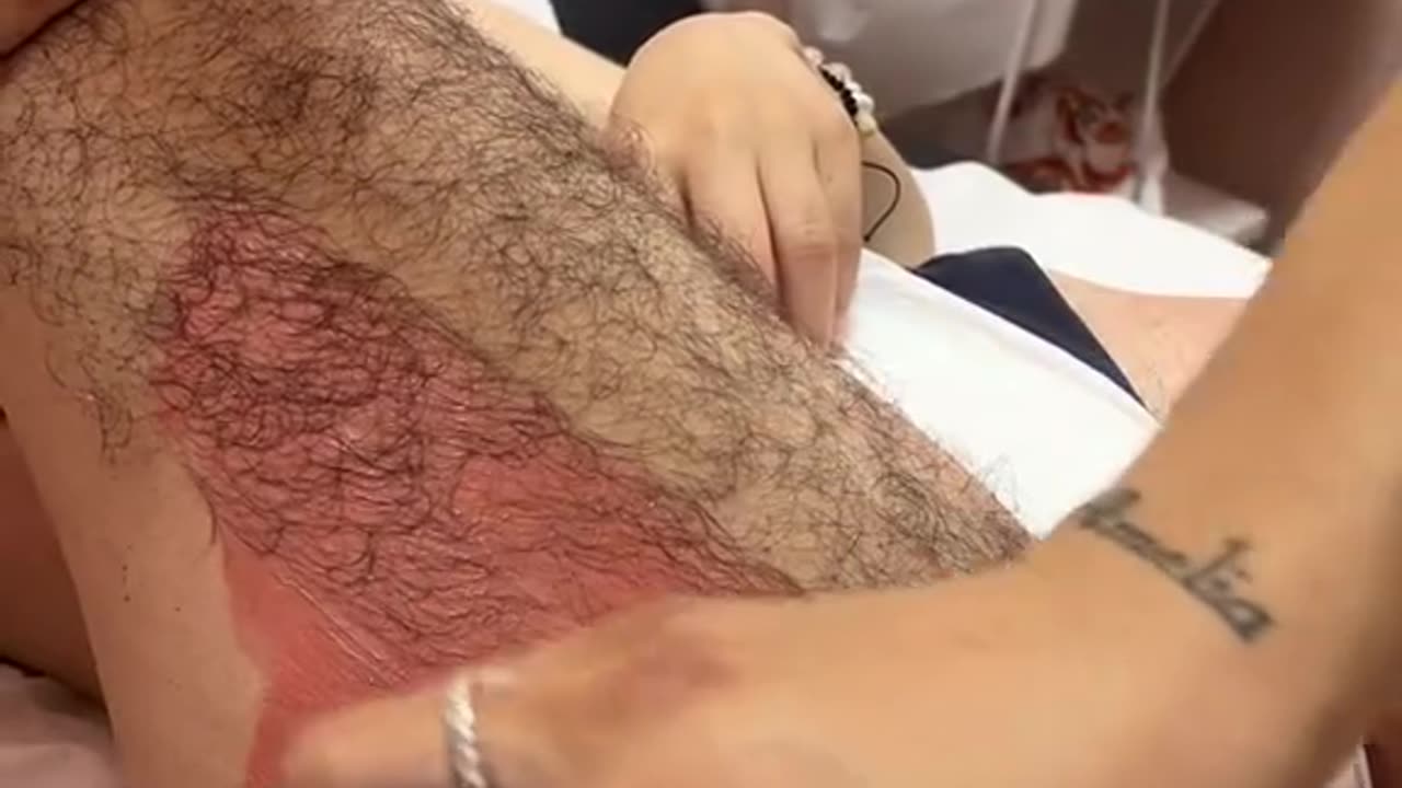 Hair removal techniques