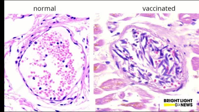 Dr Bhakdi Sucharit Virologist and Dr Arne Burkhardt Pathologist Evidence of cell attack of the organ of the dead vaxxed injuries from mRNA Covid Vaccines