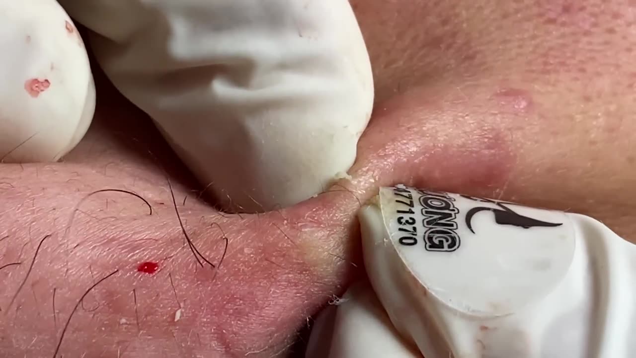 Acne Treatment Huong Da Nang# 029