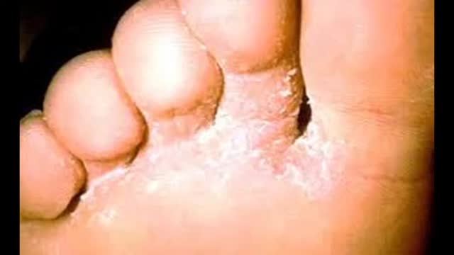 magic traitement de leczéma avec sucre glacé seulement