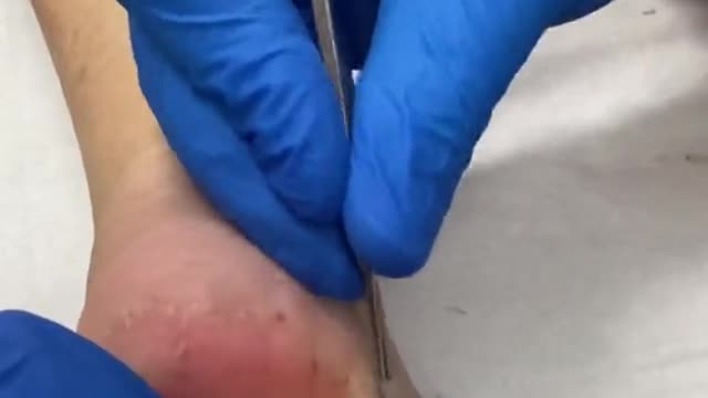 Cracked heel callus removal by Australian podiatrist